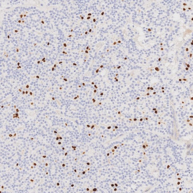 IHC staining of human pituitary adenoma using 87051-3-RR (same clone as 87051-3-PBS)