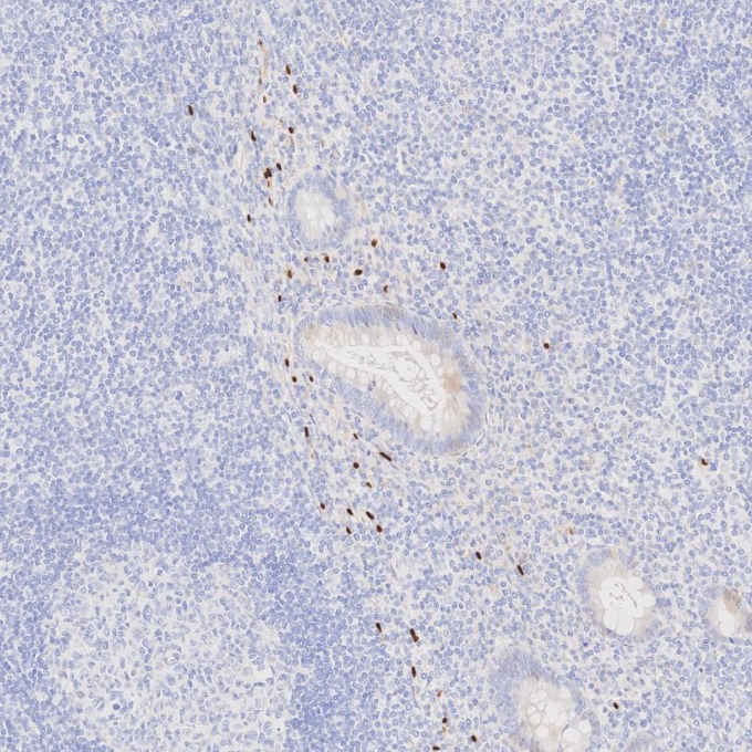 IHC staining of human appendicitis using 87051-3-RR (same clone as 87051-3-PBS)