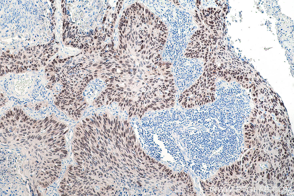 IHC staining of human lung cancer using 66411-1-Ig