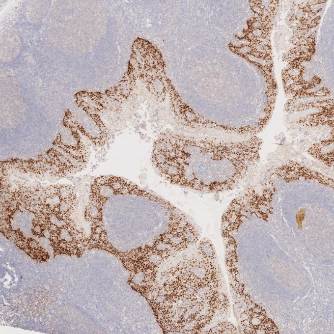 IHC staining of human tonsillitis using 66411-1-Ig IHC staining of human tonsillitis using 66411-1-Ig