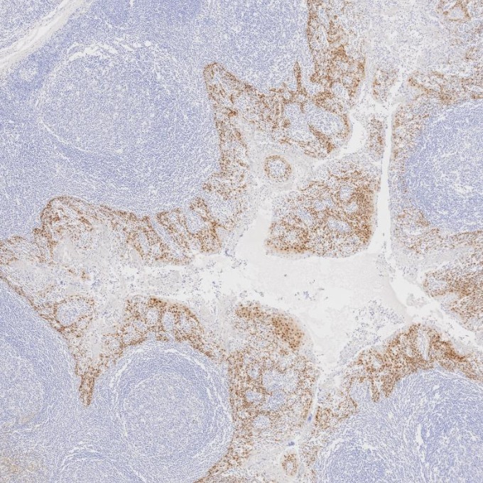 IHC staining of human tonsillitis using 66411-1-Ig IHC staining of human tonsillitis using 66411-1-Ig