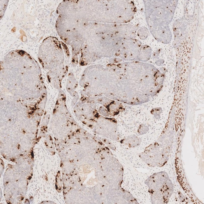 IHC staining of human skin cancer using 66411-1-Ig IHC staining of human skin cancer using 66411-1-Ig