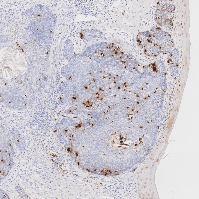 IHC staining of human skin cancer using 66411-1-Ig IHC staining of human skin cancer using 66411-1-Ig