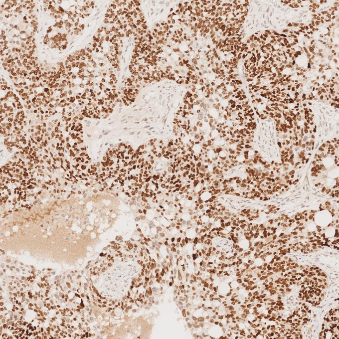 IHC staining of human ovary cancer using 66411-1-Ig IHC staining of human ovary cancer using 66411-1-Ig