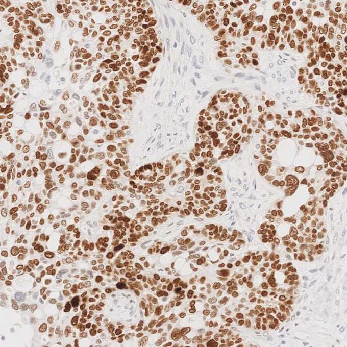 IHC staining of human ovary cancer using 66411-1-Ig IHC staining of human ovary cancer using 66411-1-Ig