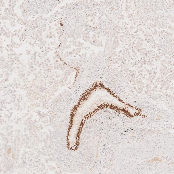 IHC staining of human lung cancer using 66411-1-Ig IHC staining of human lung cancer using 66411-1-Ig