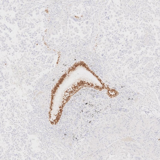 IHC staining of human lung cancer using 66411-1-Ig IHC staining of human lung cancer using 66411-1-Ig