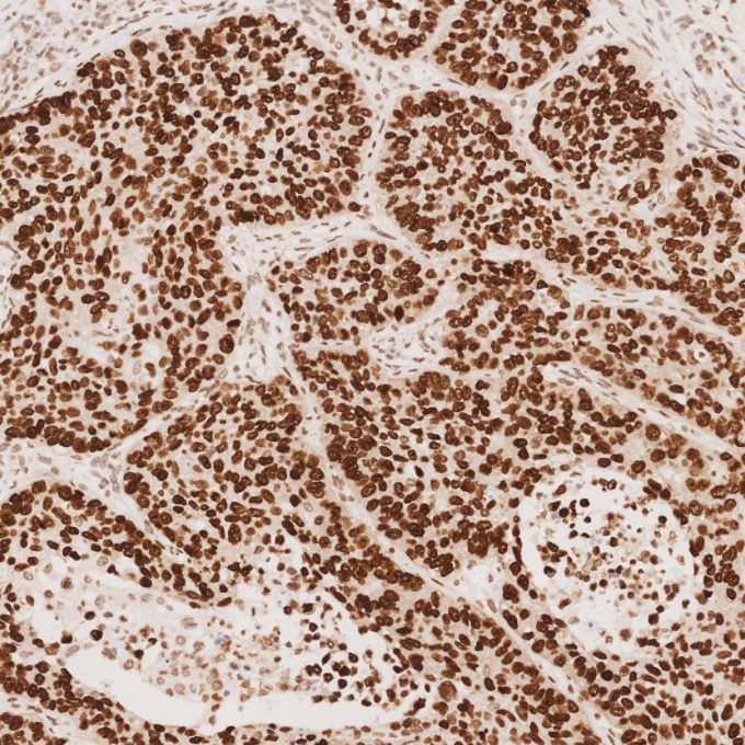 IHC staining of human lung cancer using 66411-1-Ig IHC staining of human lung cancer using 66411-1-Ig