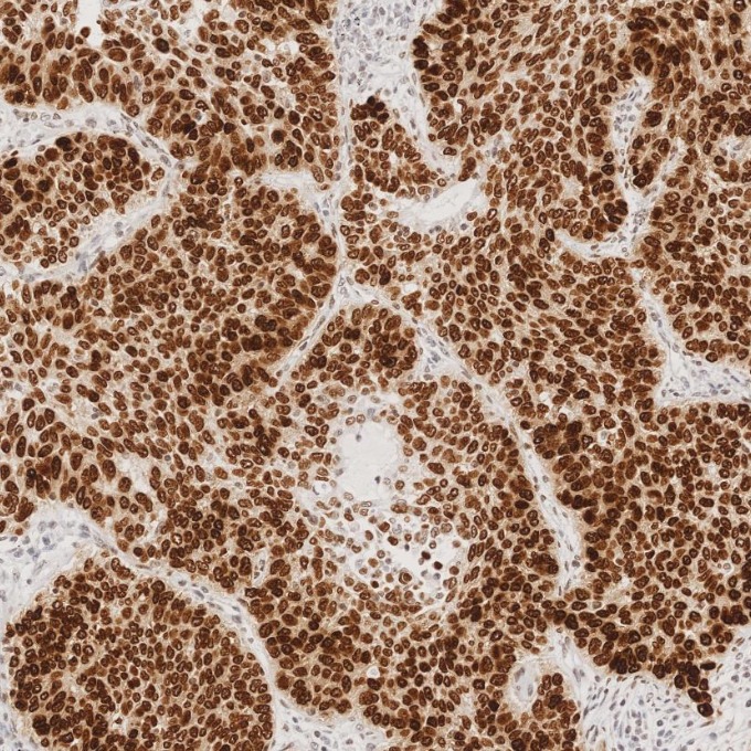 IHC staining of human lung cancer using 66411-1-Ig IHC staining of human lung cancer using 66411-1-Ig