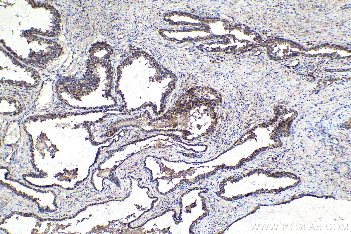 IHC staining of human prostate cancer using 23925-1-AP