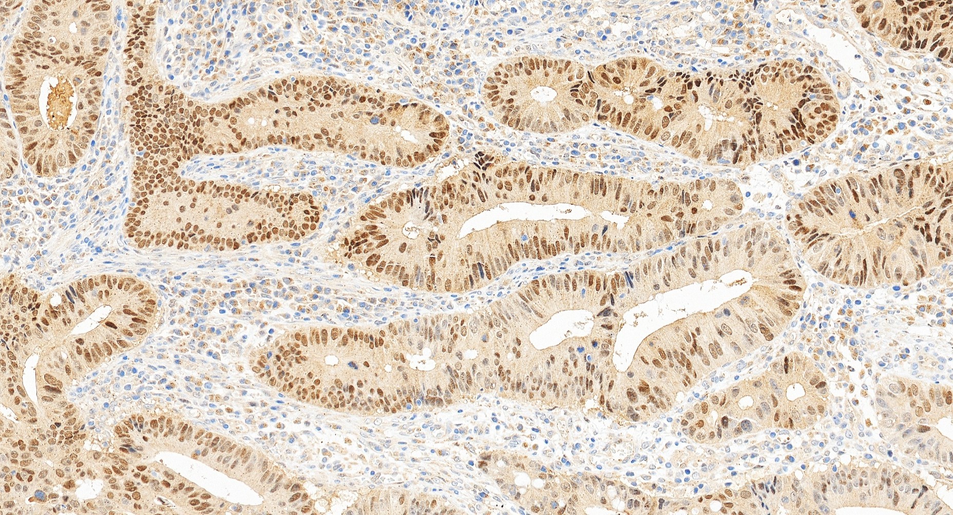 IHC staining of human colon cancer using 27526-1-AP IHC staining of human colon cancer using 27526-1-AP