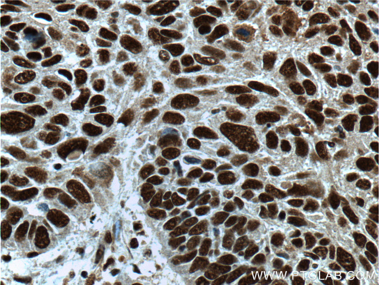 IHC staining of human lung cancer using 21962-1-AP