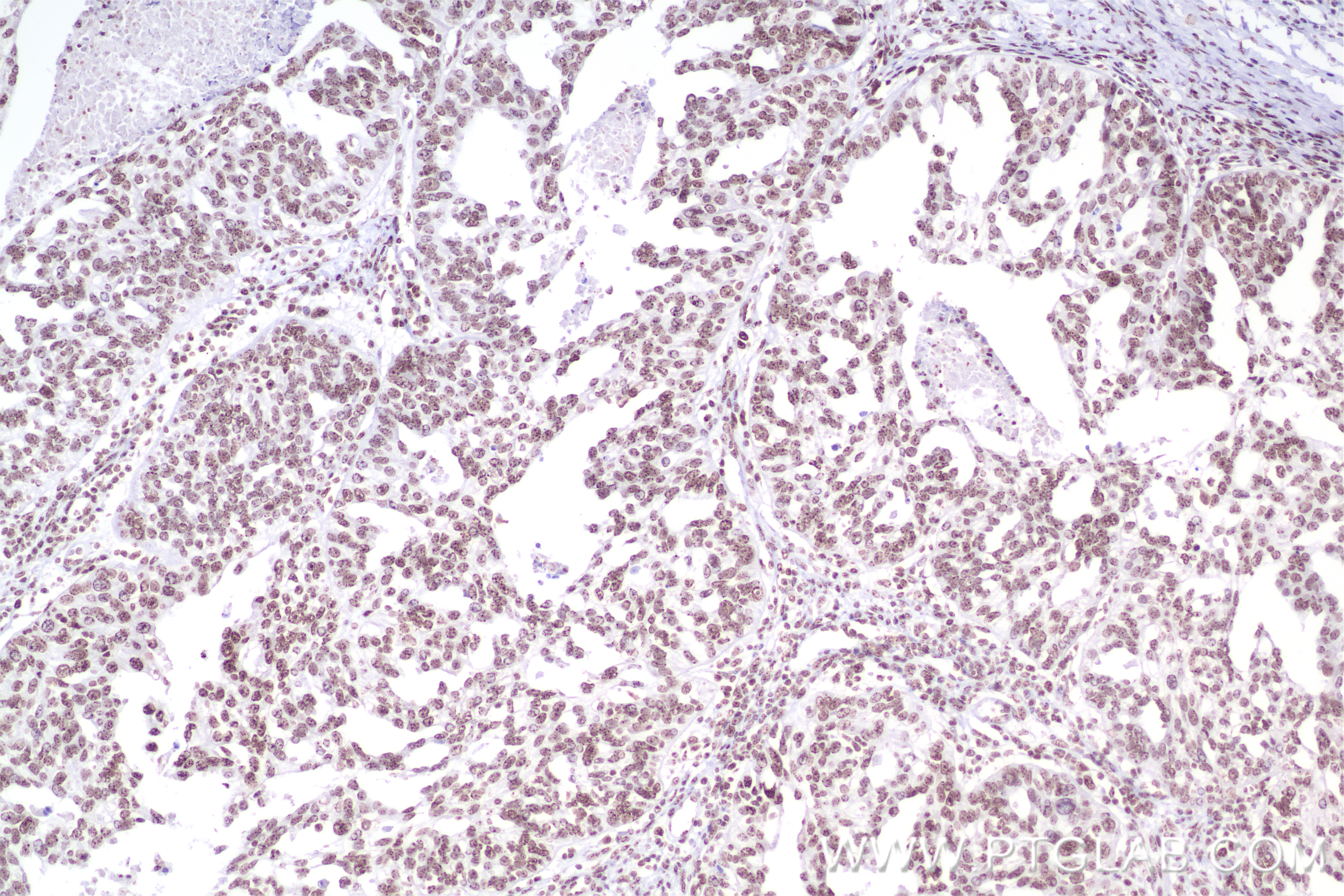 IHC staining of human ovary cancer using 84012-5-RR (same clone as 84012-5-PBS)
