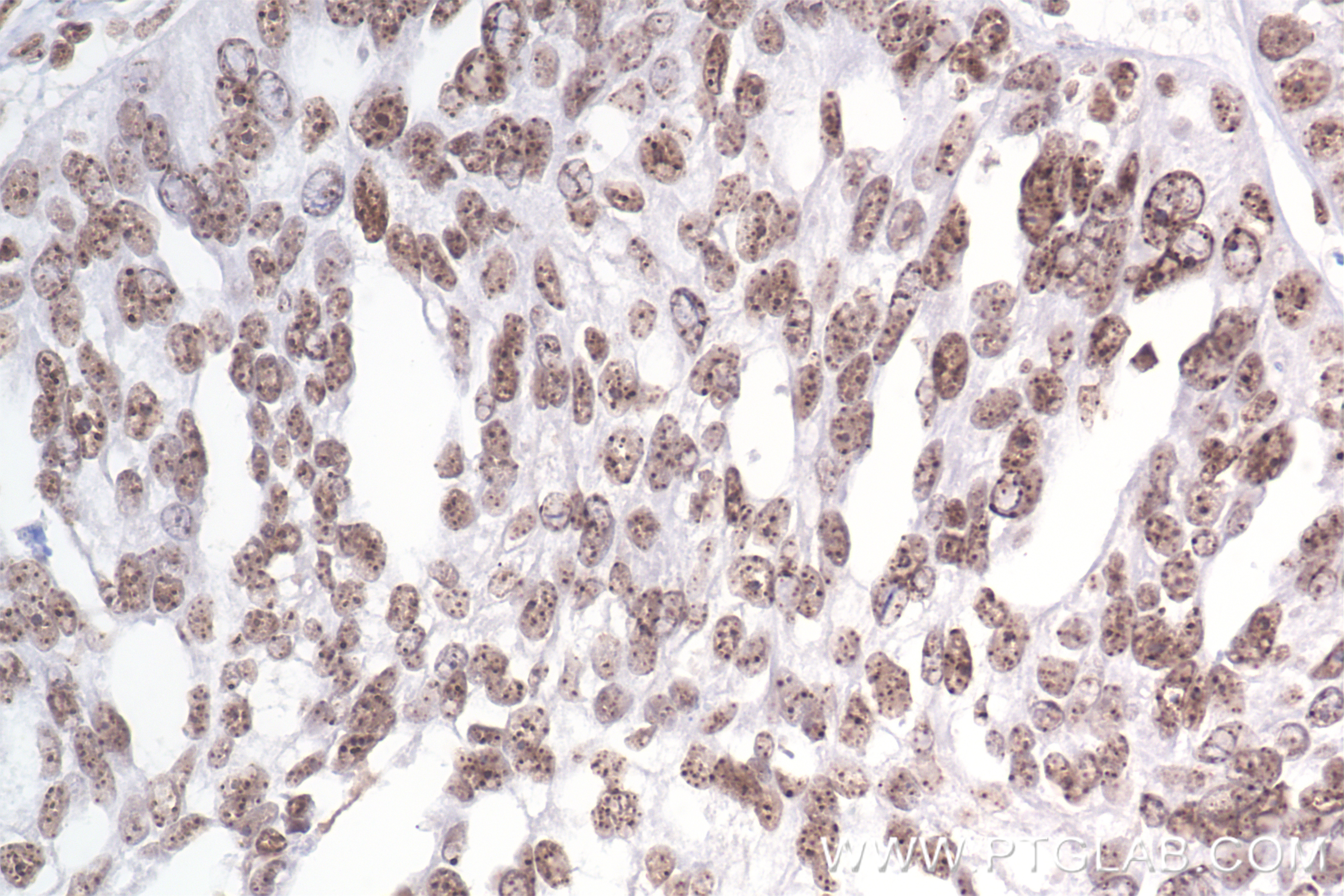 IHC staining of human ovary cancer using 84012-5-RR (same clone as 84012-5-PBS)