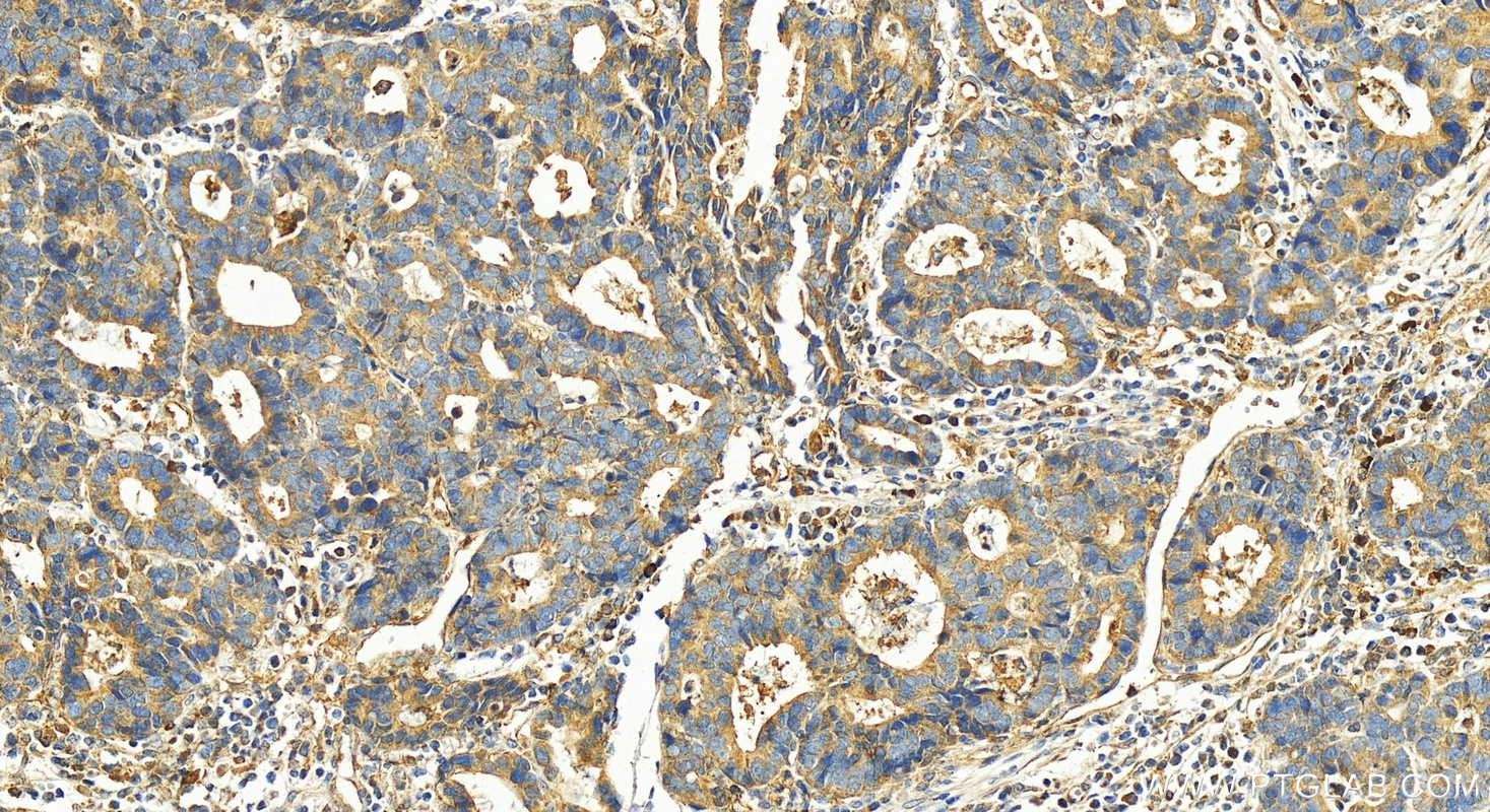 IHC staining of human stomach cancer using 28561-1-AP