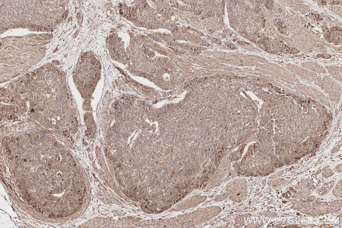 IHC staining of human stomach cancer using 14726-1-AP