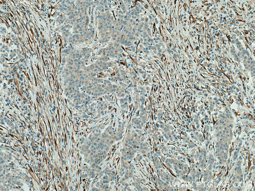 IHC staining of human stomach cancer using 15274-1-AP
