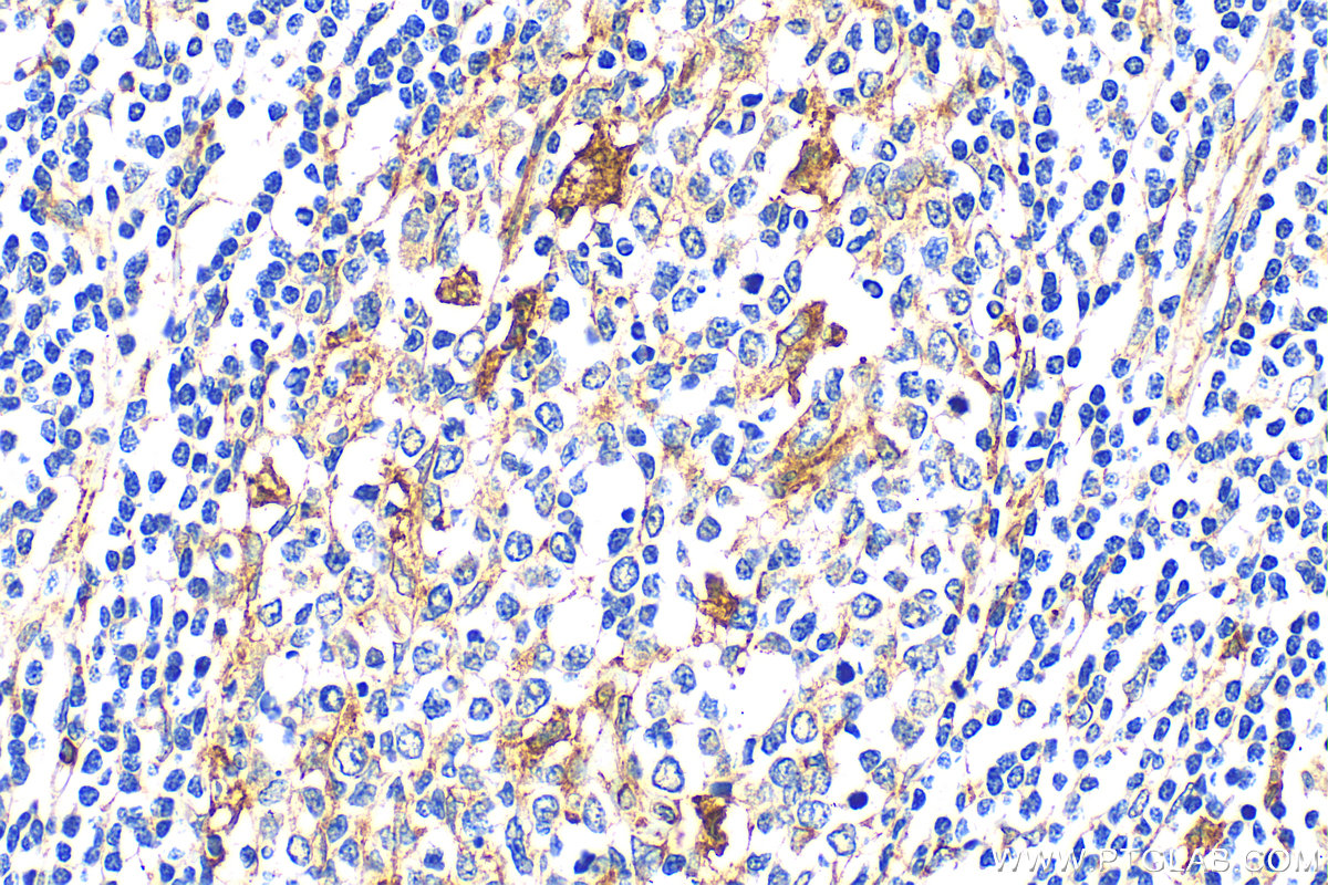 IHC staining of human stomach cancer using 15274-1-AP