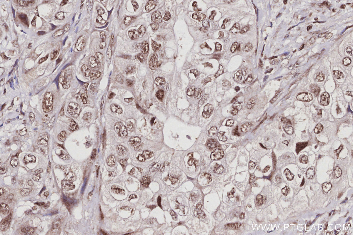 IHC staining of human pancreas cancer using 67361-1-Ig IHC staining of human pancreas cancer using 67361-1-Ig