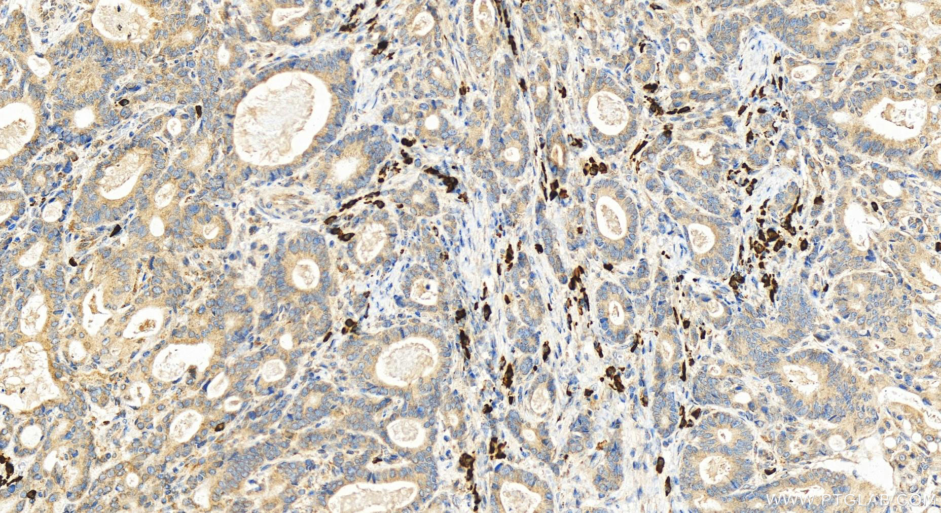 IHC staining of human stomach cancer using 14872-1-AP