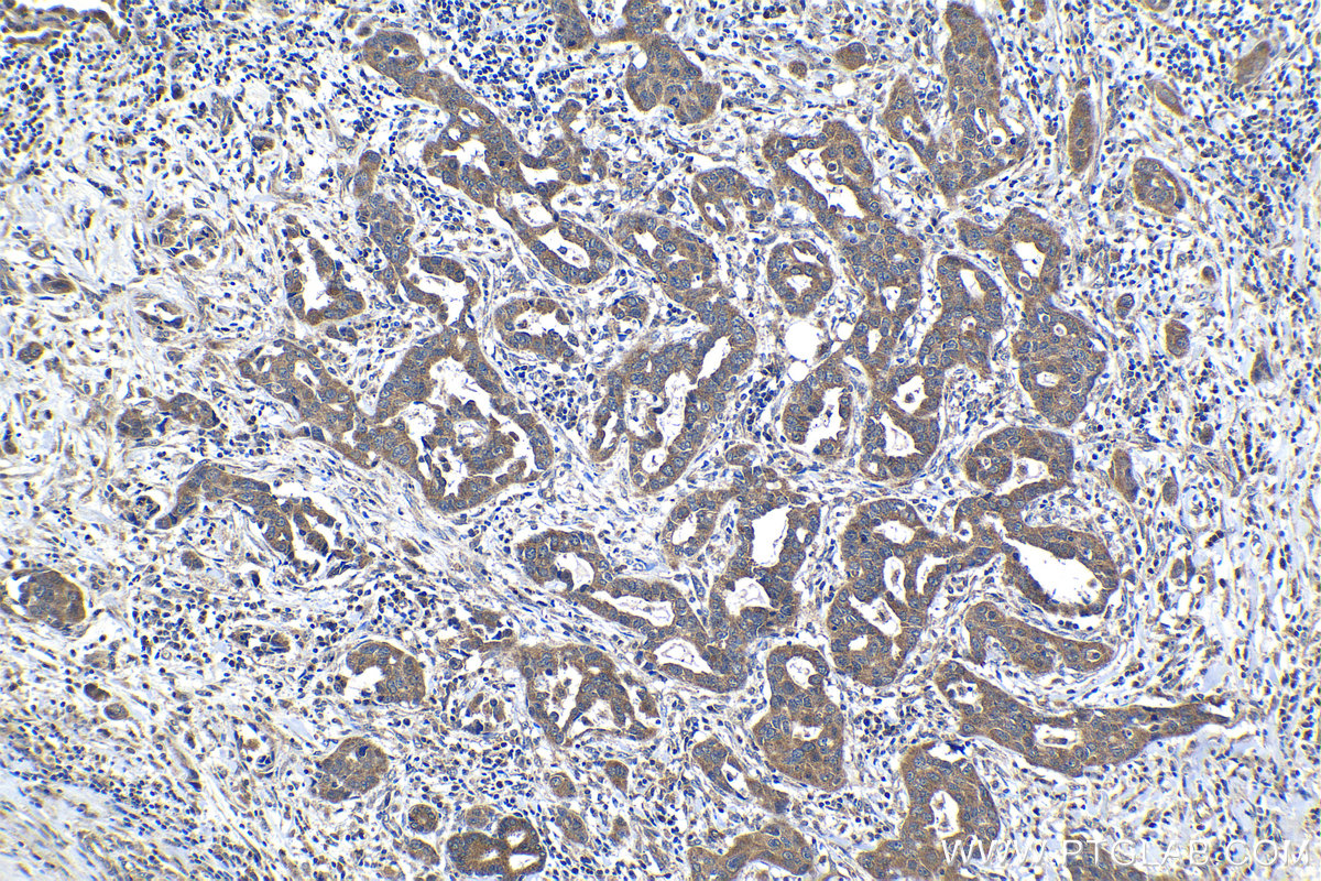 Immunohistochemical analysis of paraffin-embedded human lung cancer tissue slide using 22471-1-AP (SPDYC antibody) at dilution of 1:500 (under 10x lens). Heat mediated antigen retrieval with Tris-EDTA buffer (pH 9.0). IHC staining of human lung cancer using 22471-1-AP