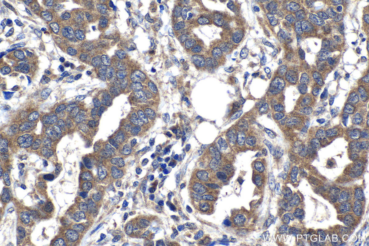 Immunohistochemical analysis of paraffin-embedded human lung cancer tissue slide using 22471-1-AP (SPDYC antibody) at dilution of 1:500 (under 40x lens). Heat mediated antigen retrieval with Tris-EDTA buffer (pH 9.0). IHC staining of human lung cancer using 22471-1-AP
