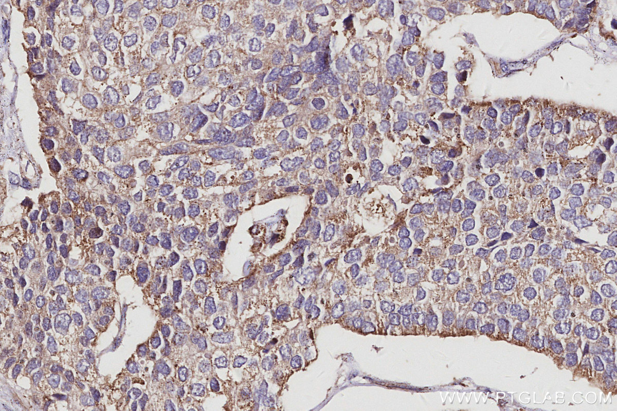 IHC staining of human stomach cancer using 10670-1-AP IHC staining of human stomach cancer using 10670-1-AP
