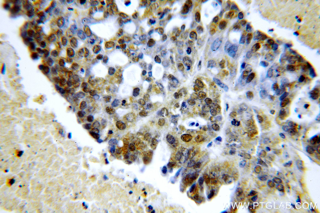 IHC staining of human ovary tumor using 19531-1-AP