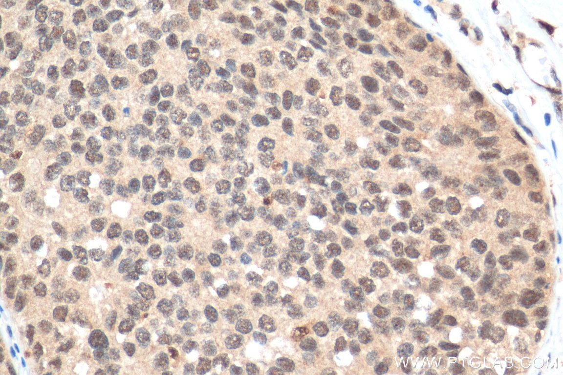 IHC staining of human breast cancer using 10107-2-AP