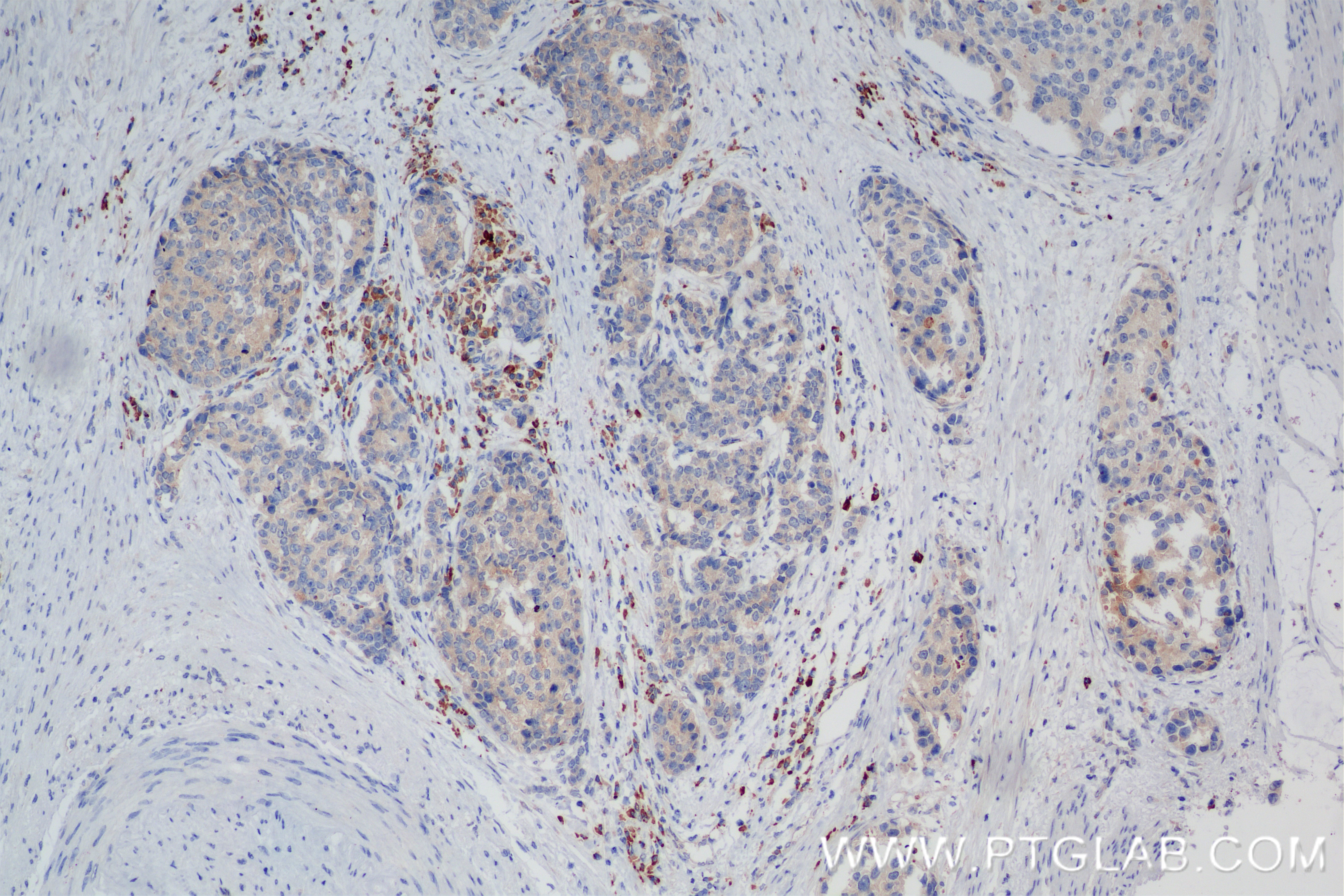 IHC staining of human stomach cancer using 84977-1-RR