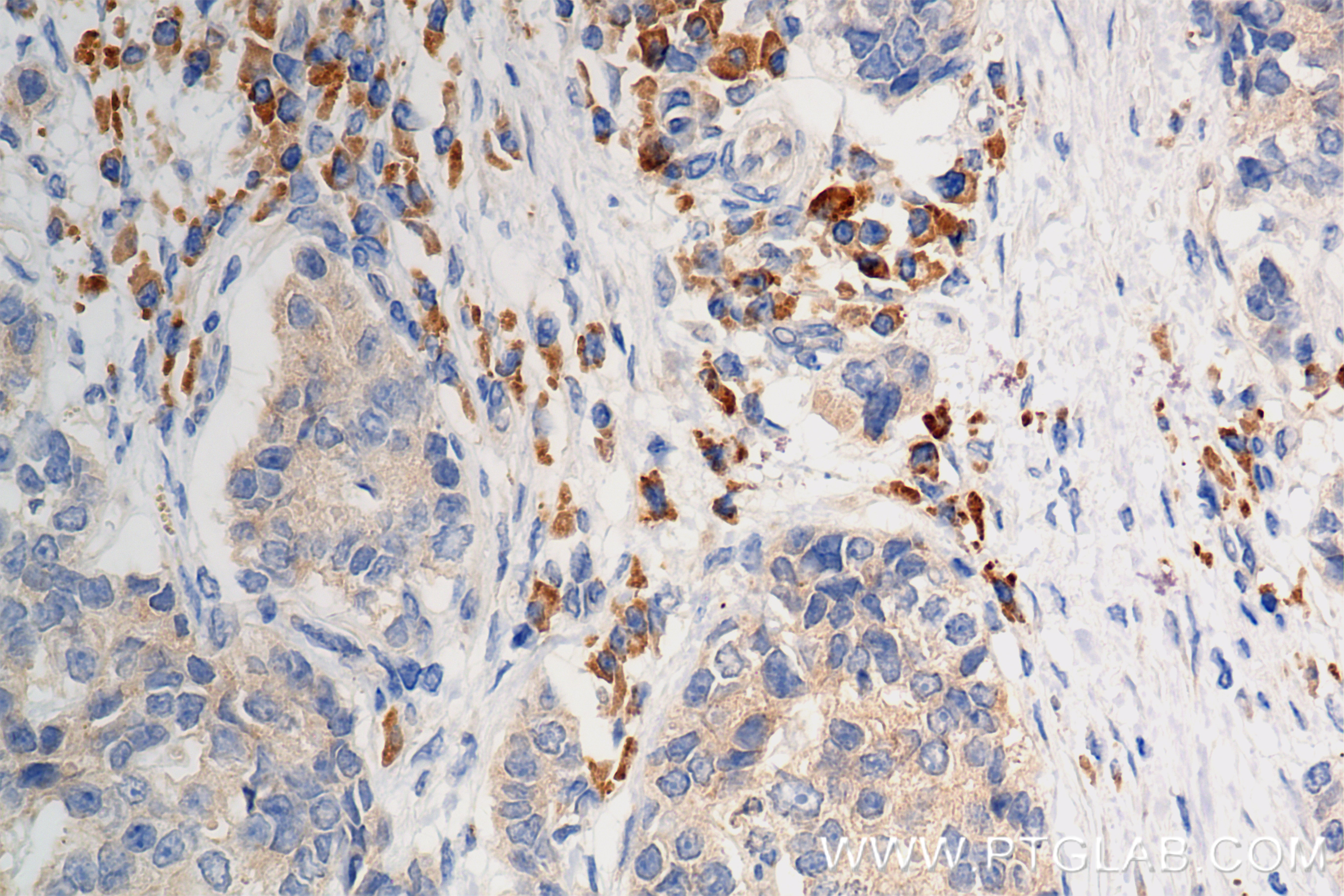 IHC staining of human stomach cancer using 84977-1-RR