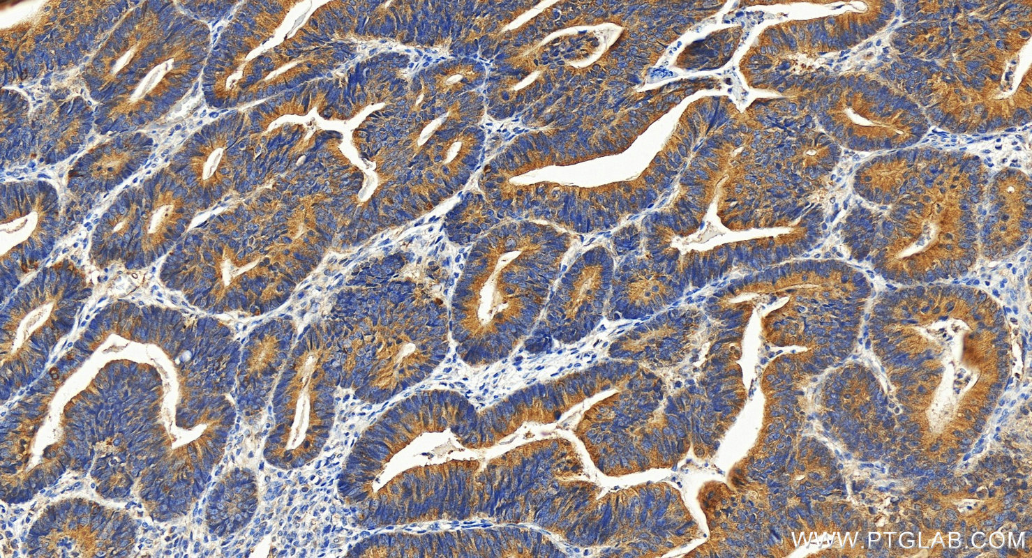 IHC staining of human colon cancer using 26135-1-AP IHC staining of human colon cancer using 26135-1-AP