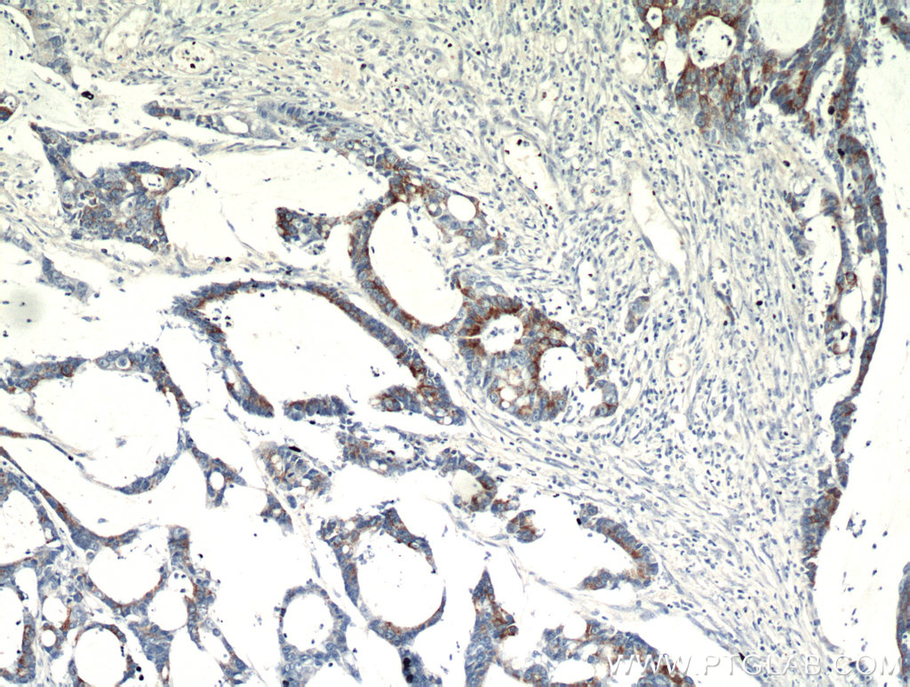 IHC staining of human colon cancer using 11742-1-AP