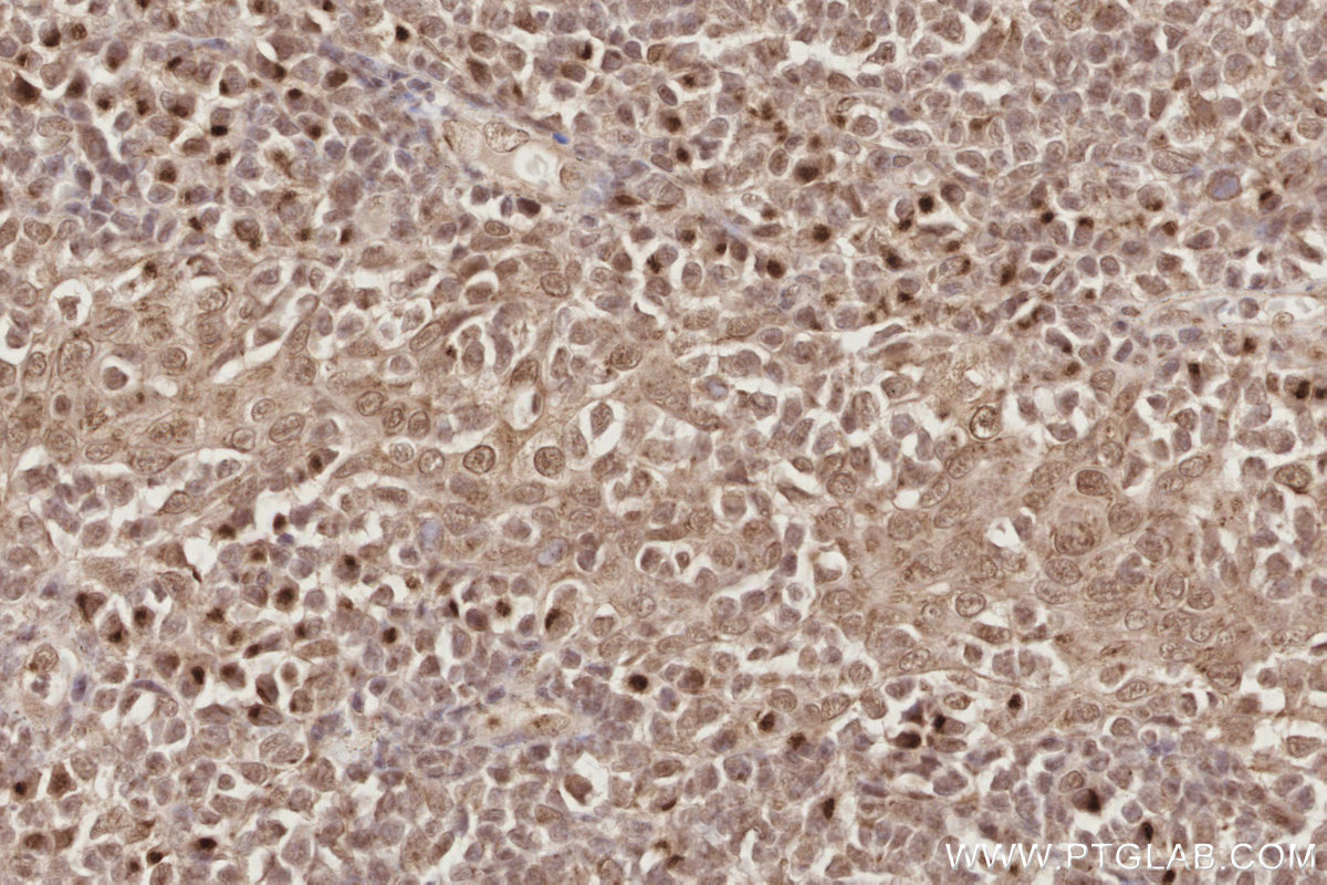 IHC staining of human tonsillitis using 24850-1-AP (same clone as 24850-1-PBS) IHC staining of human tonsillitis using 24850-1-AP (same clone as 24850-1-PBS)