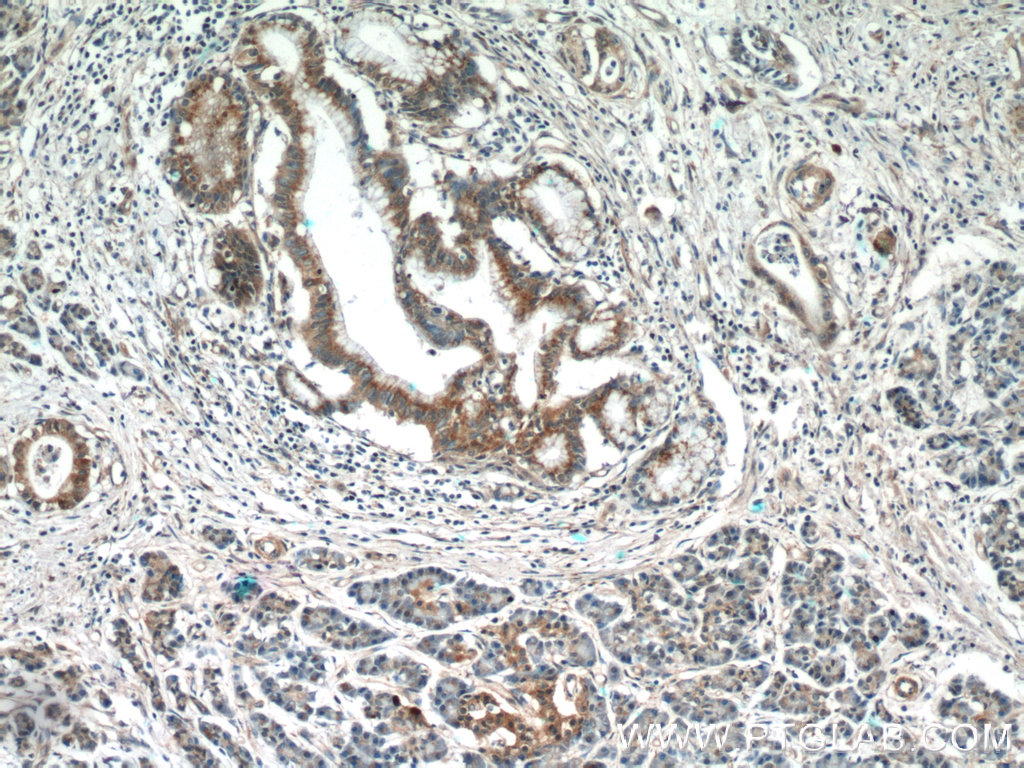 IHC staining of human pancreas cancer using 11383-1-AP