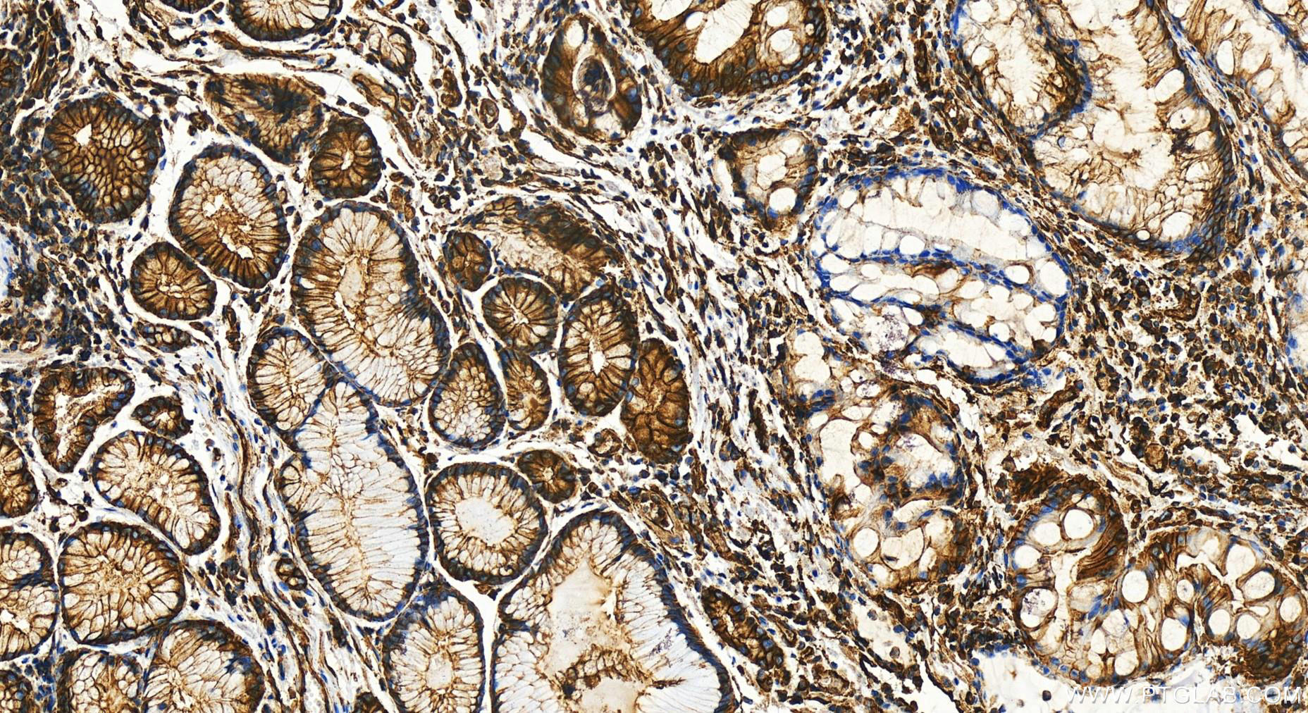 IHC staining of human stomach cancer using 31676-1-AP