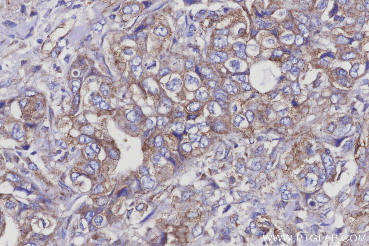 IHC staining of human pancreas cancer using 68094-1-Ig IHC staining of human pancreas cancer using 68094-1-Ig