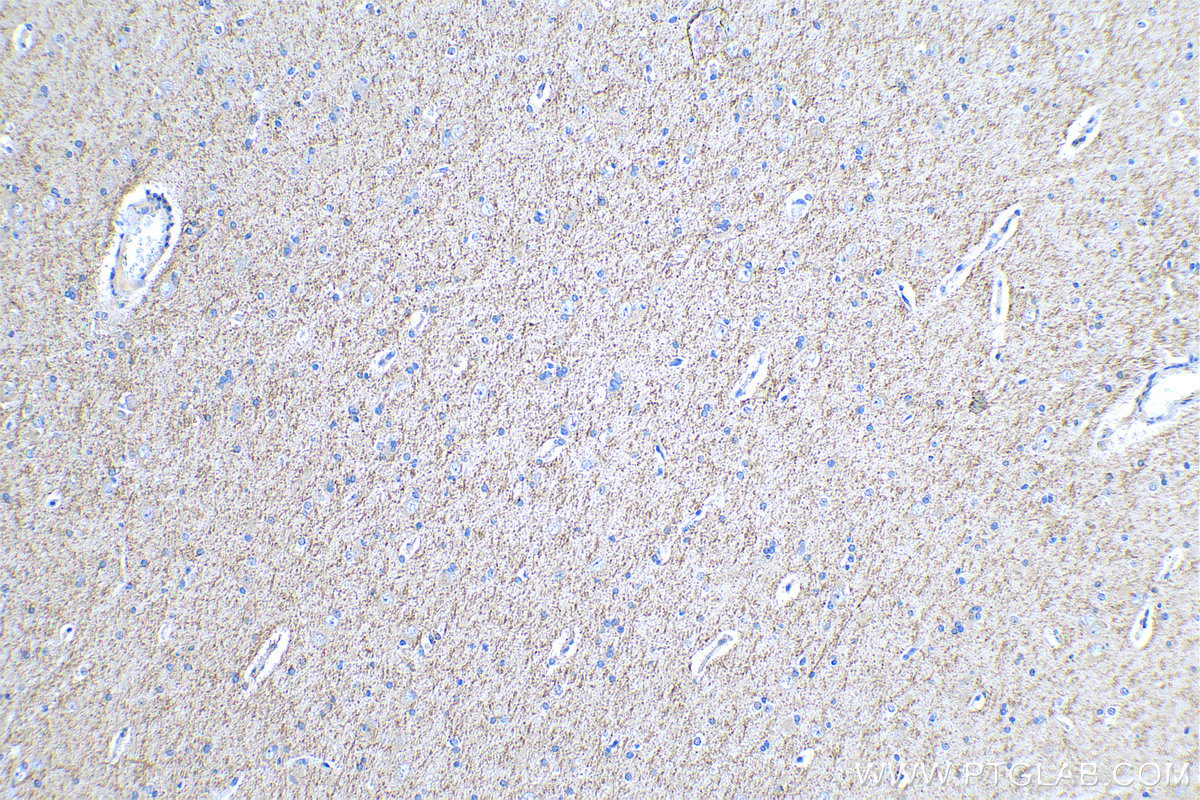 IHC staining of human gliomas using 18420-1-AP