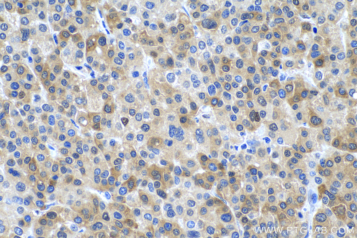 IHC staining of human liver cancer using 18420-1-AP