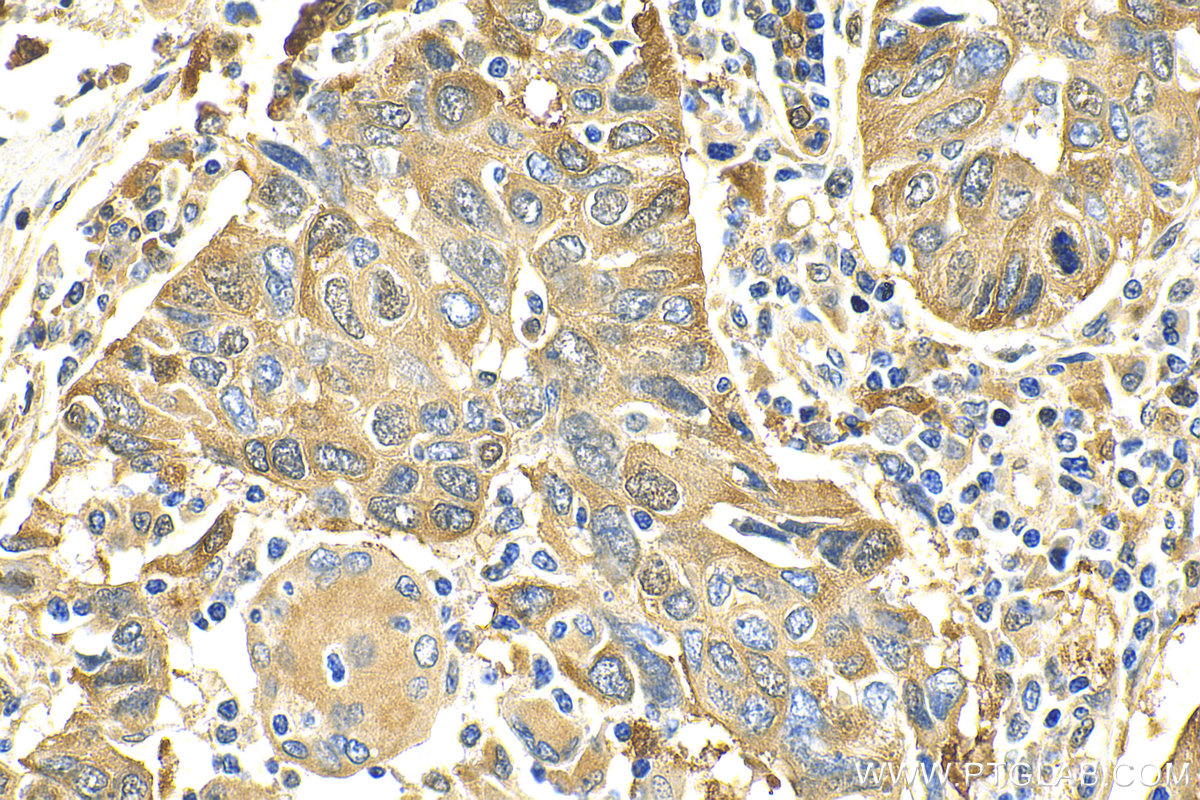 IHC staining of human lung cancer using 18420-1-AP