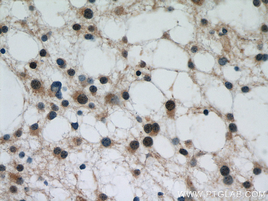 IHC staining of human gliomas using 18420-1-AP