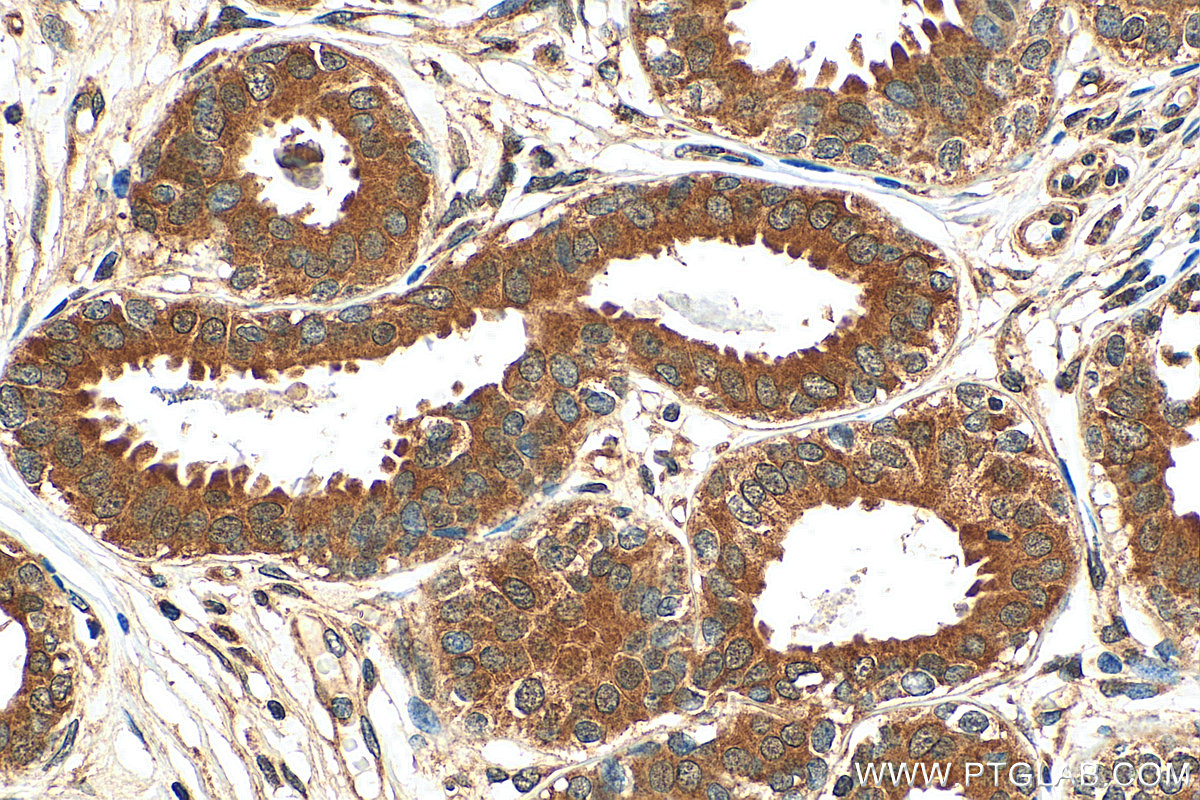 IHC staining of human breast cancer using 11729-1-AP