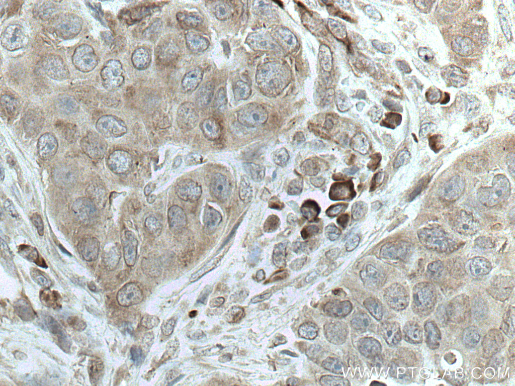 IHC staining of human breast cancer using 67005-1-Ig