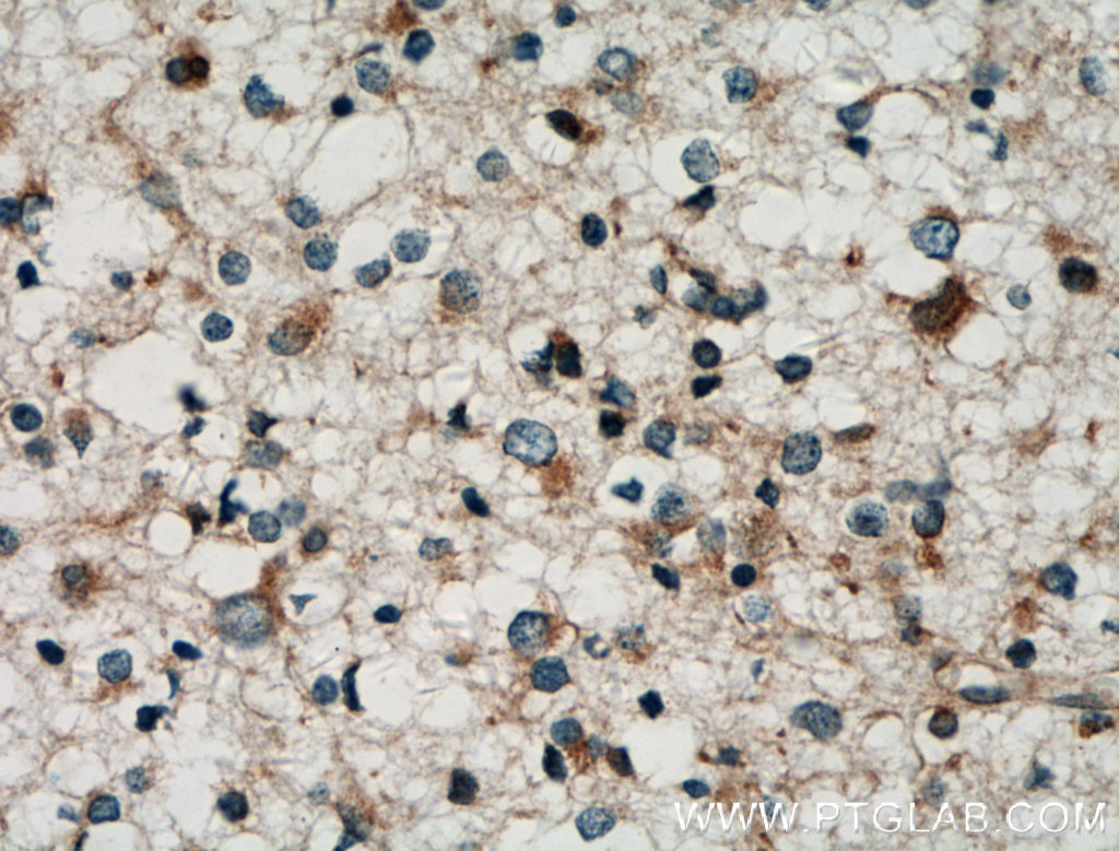 IHC staining of human gliomas using 11585-1-AP