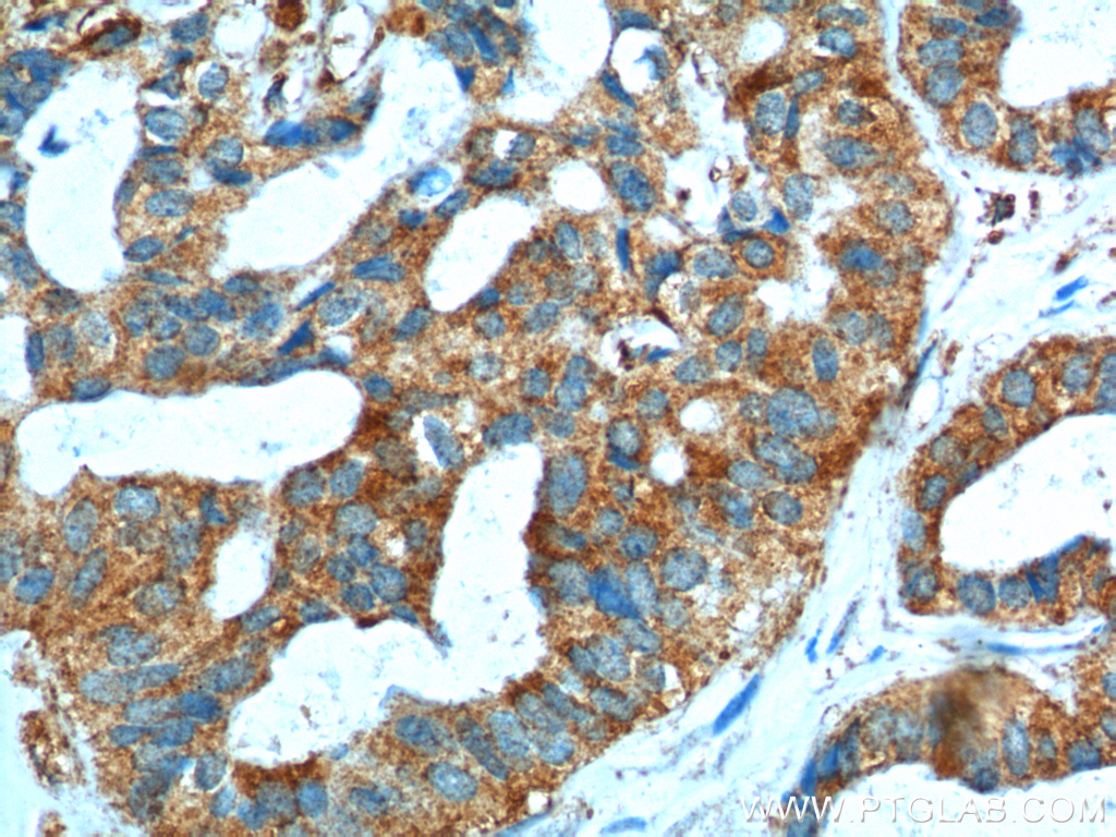 IHC staining of human breast cancer using 14073-1-AP