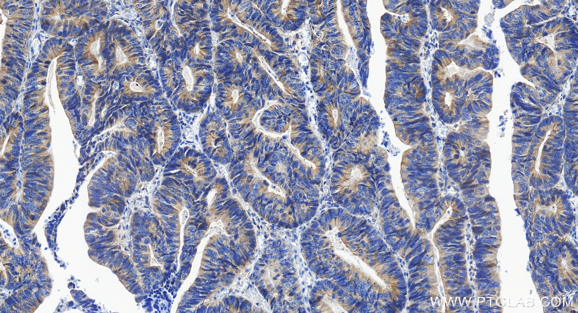 IHC staining of human colon cancer using 85613-5-RR