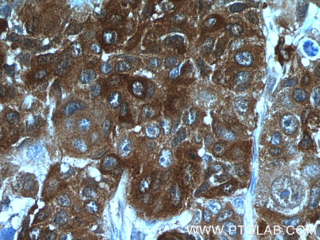 IHC staining of human lung cancer using 14273-1-AP