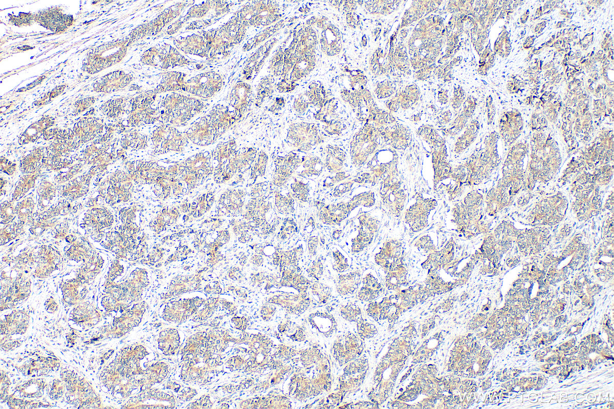 IHC staining of human prostate cancer using 11817-1-AP