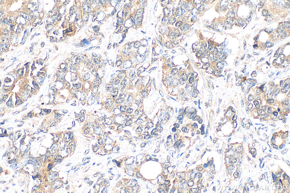 IHC staining of human prostate cancer using 11817-1-AP