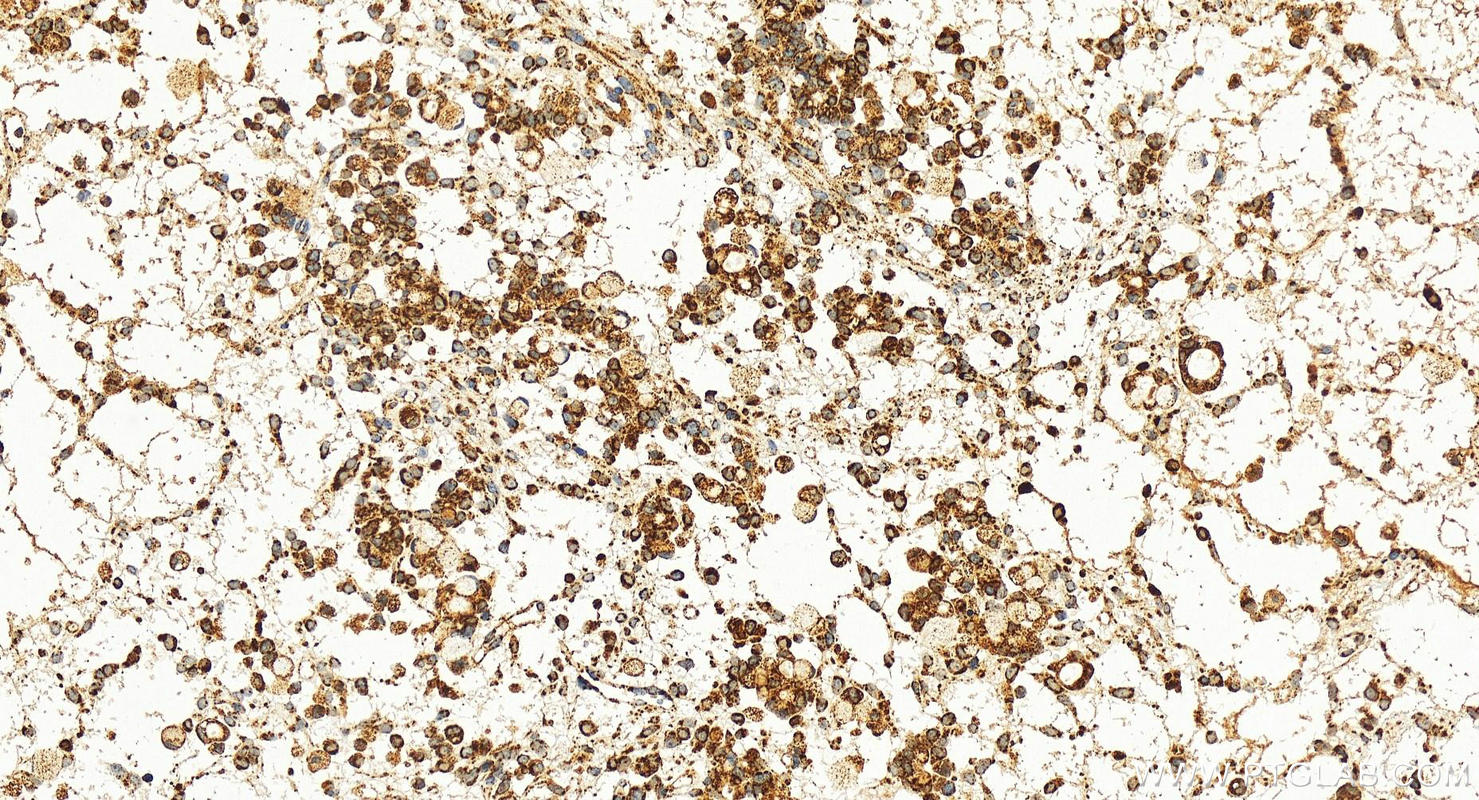 IHC staining of human ovary cancer using 12212-1-AP